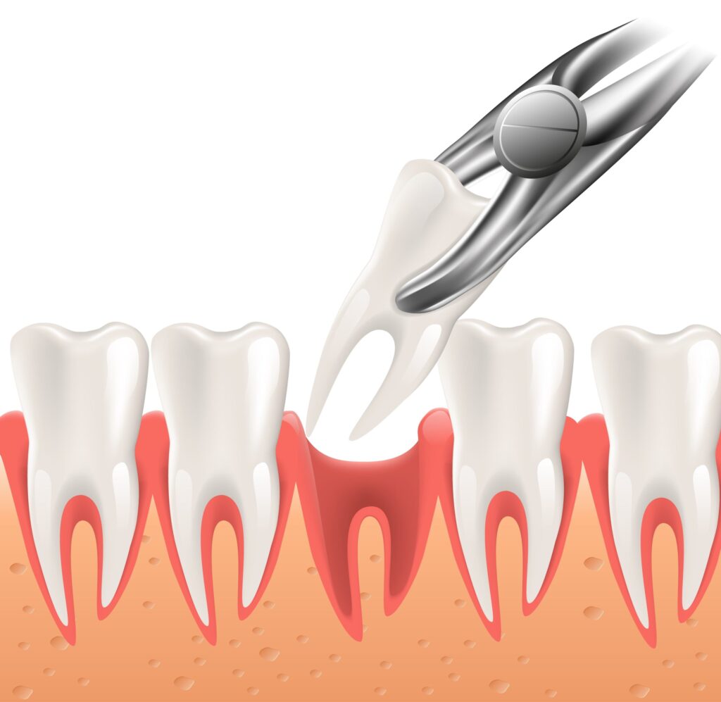 tooth extractions Edgemont dentist